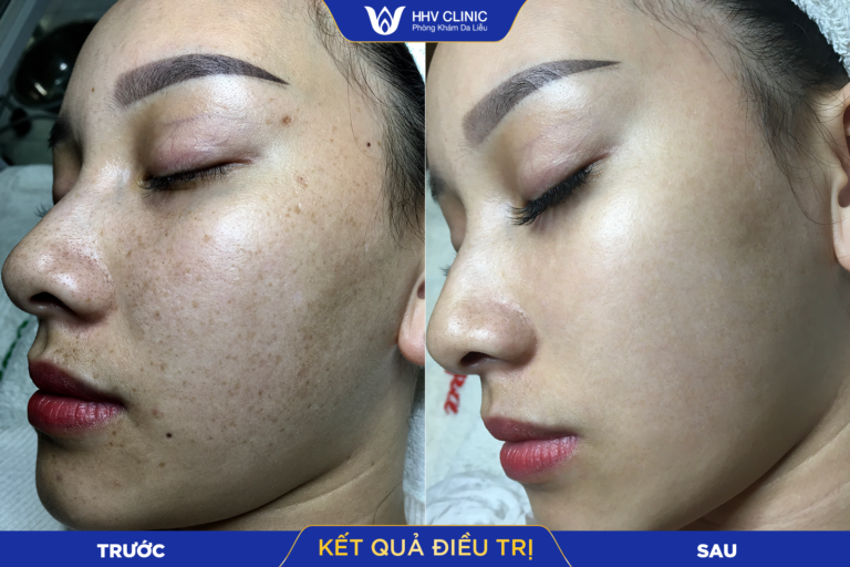 Da sáng mịn đều màu cùng phương pháp Oxy Jet